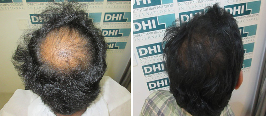 DHI before & after hair transplant results